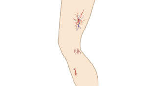 Image of a leg with spider veins