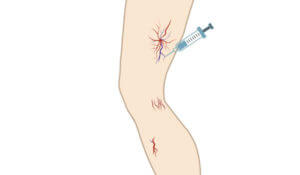 Image of spider veins being treated with sclerotherapy