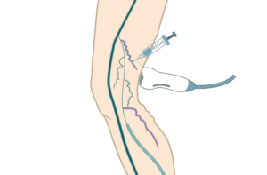 Image of how ultrasound is used to locate the vein under the skin for sclerotherapy