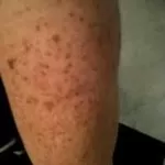 brown spots on legs