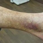 brown spots ankle