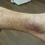 足首の茶色の斑点