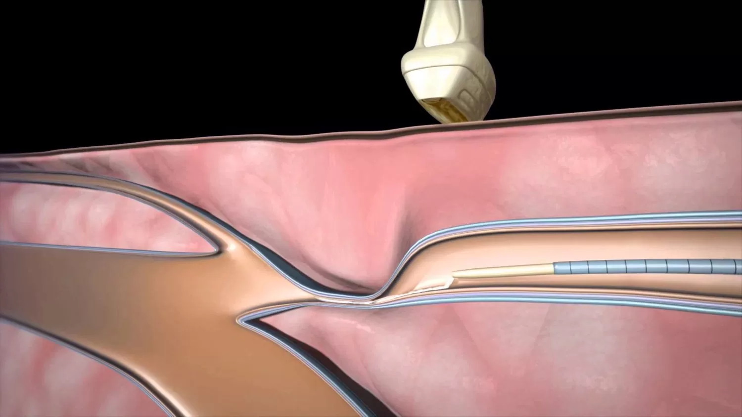VenaSeal Closure System The Ultimate Vein Guide